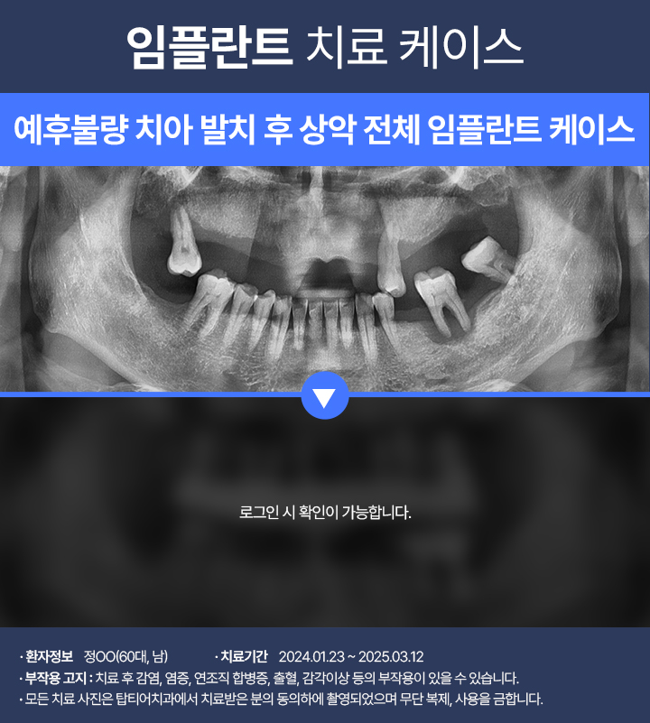 임플란트 케이스01