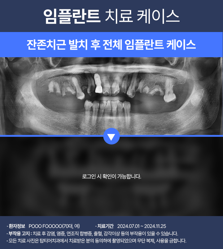 임플란트 케이스02