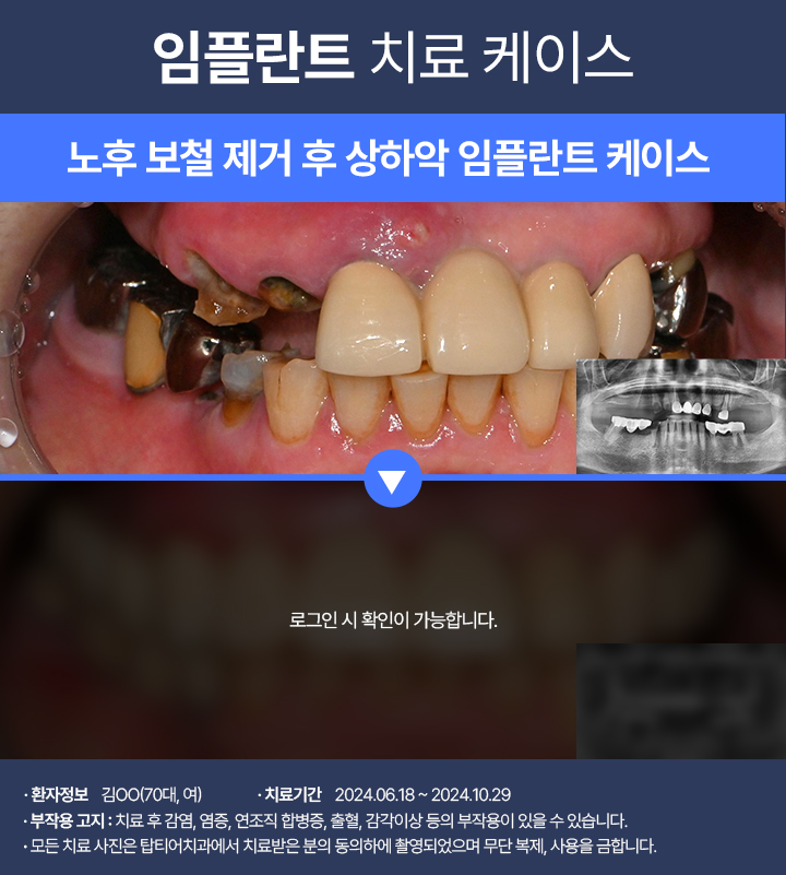 임플란트 케이스03