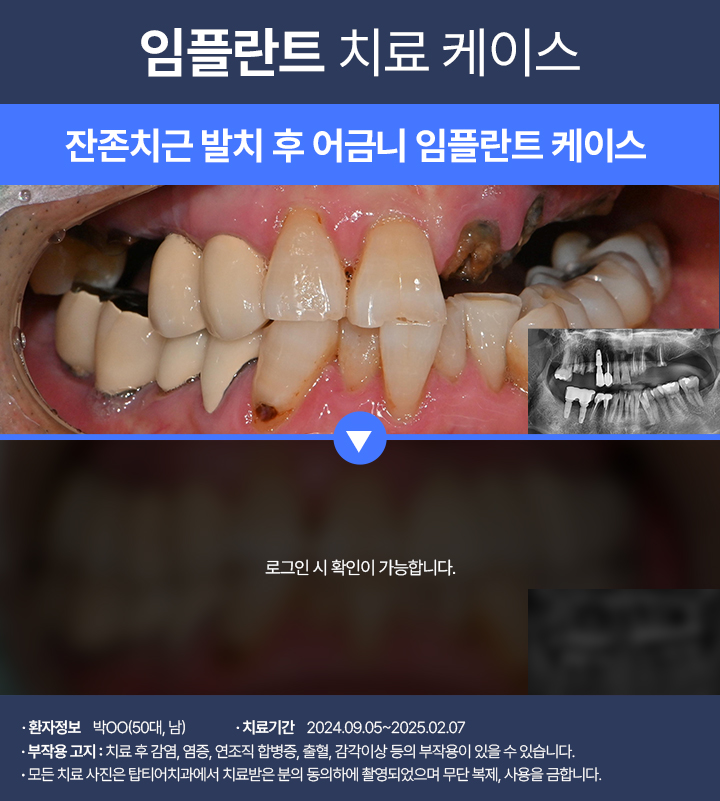 임플란트 케이스04