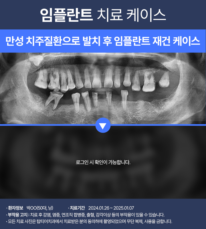 임플란트 케이스05