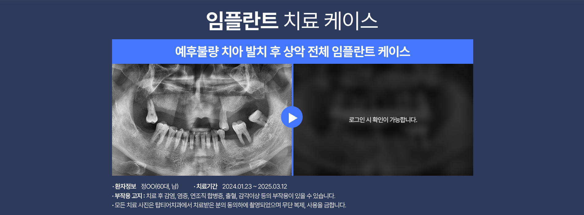 임플란트 케이스01