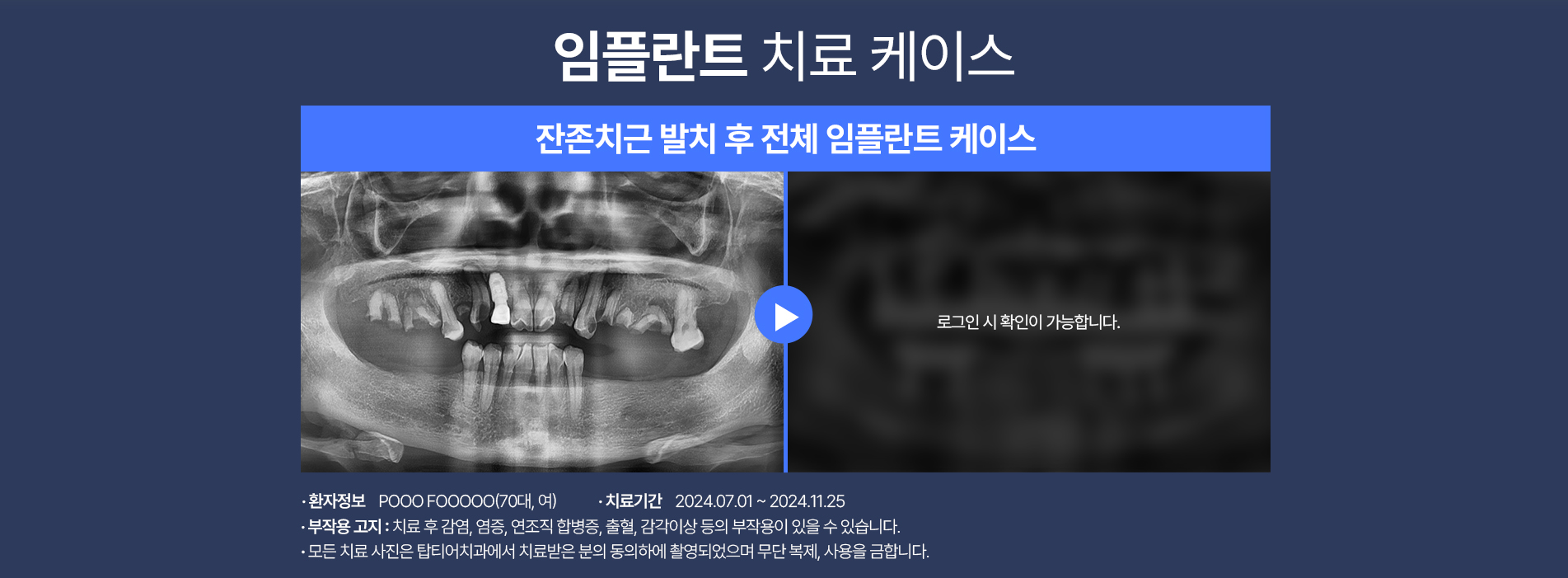 임플란트 케이스02