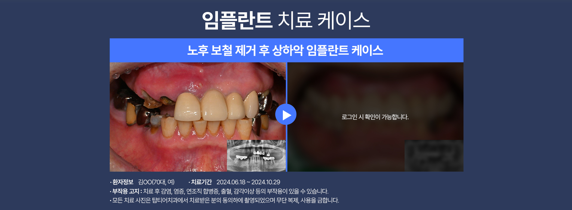 임플란트 케이스03