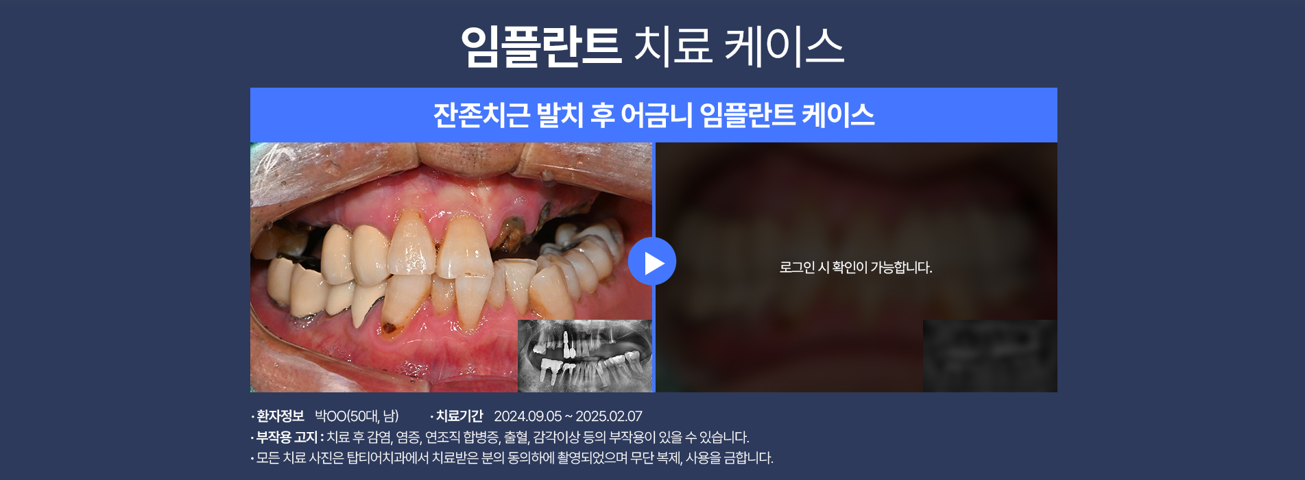 임플란트 케이스04