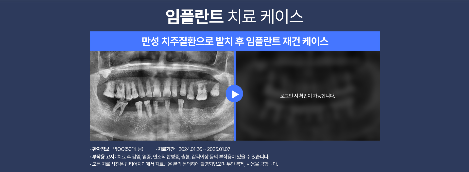 임플란트 케이스05