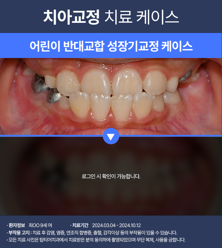 치아교정 케이스01