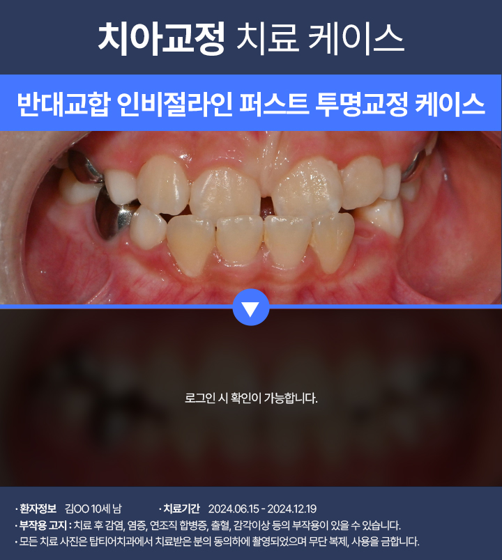 치아교정 케이스02