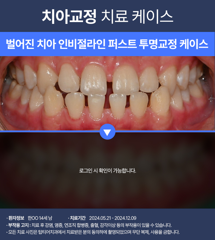 치아교정 케이스03