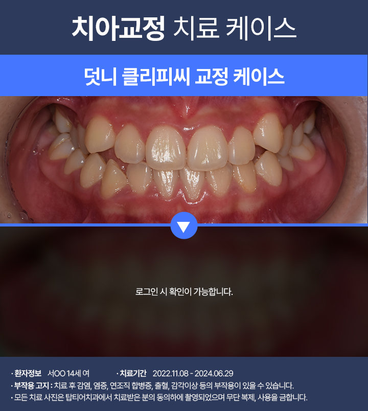 치아교정 케이스04