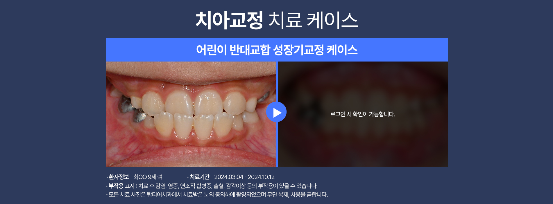 치아교정 케이스01
