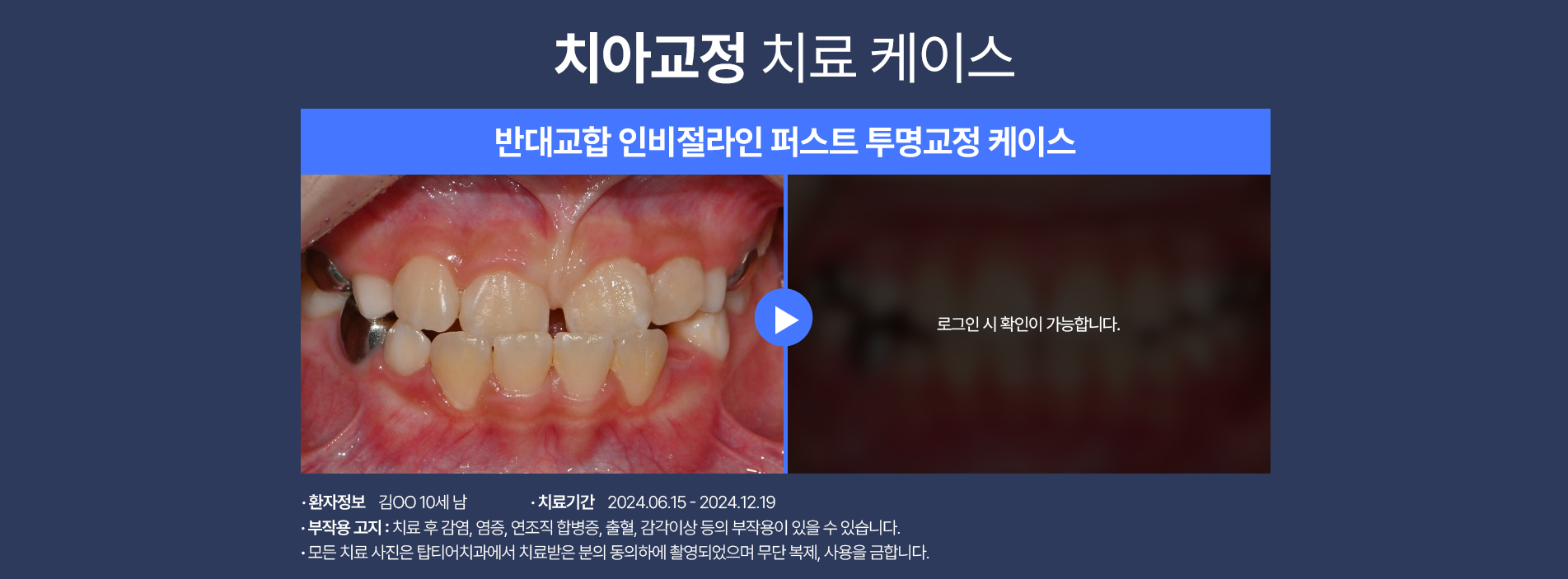 치아교정 케이스02