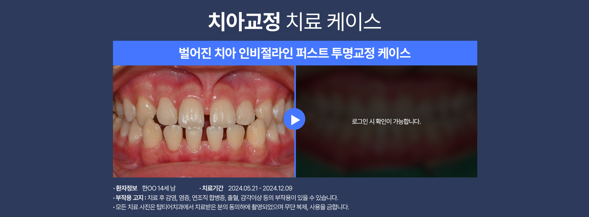 치아교정 케이스03