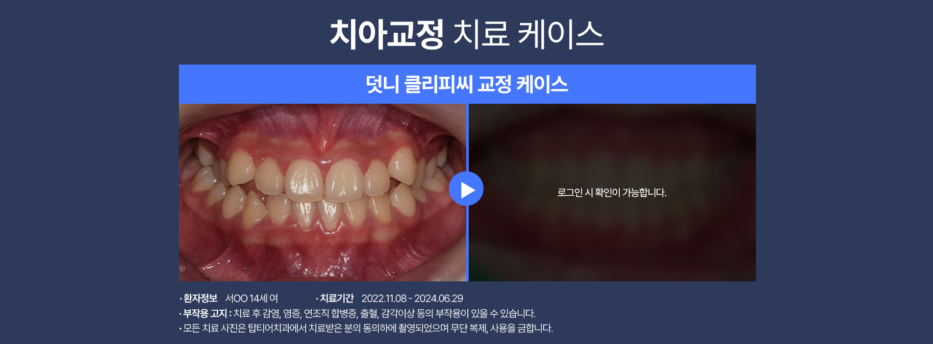 치아교정 케이스04